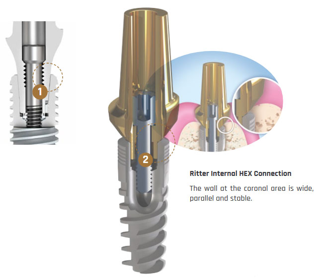 The Implant Internal HEX